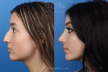 I've always been insecure about my dorsal hump and my slightly deviated septum certainly wasn't helping. . Rhinoplasty nyc reddit
